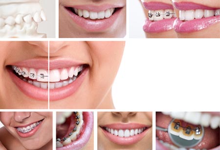 Fogszabályozás típusai